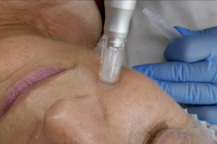 Dermalneedling