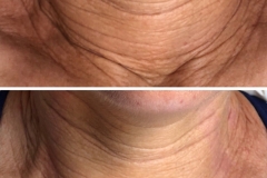 PhiLings Example Image Neck.2