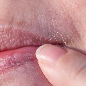 Electro-Epilation and Red Vein Elimination