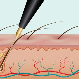 ONLINE ONLY - Electrolysis and Red Vein Course