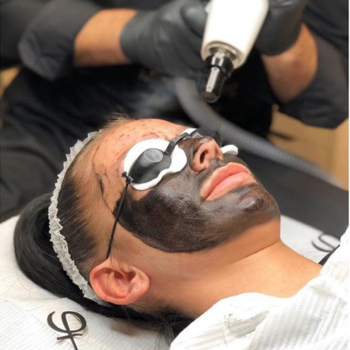 PhiLaser Carbon Facial