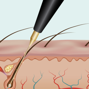Electrolysis & Red Vein Elimination | Online + 2-Day Live Training