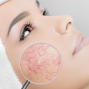 Electrolysis and Red Vein Beginners Course